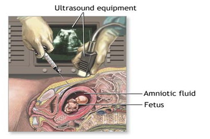 Amniocenteza